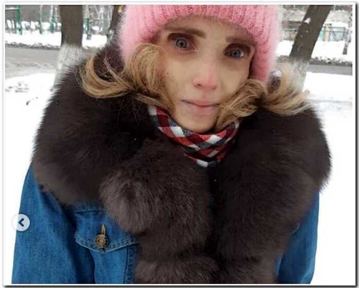 17-килограммовая россиянка выкарабкалась «с того света» и начала набирать вес
