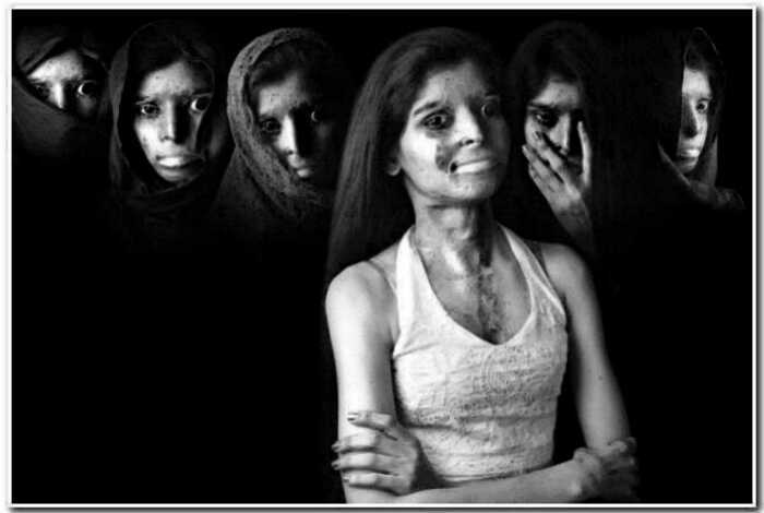 «Украденная красота»: истории индийских женщин, облитых кислотой