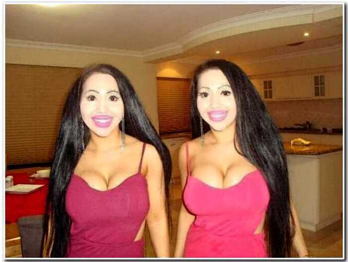 Самые похожие в мире близняшки жалеют о пластике и хотят вернуть природную внешность