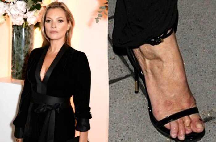 10 Голливудских звезд, которые смирились с некрасивыми пальцами ног