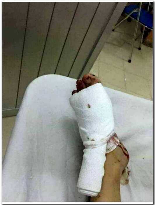 Женщина из Туниса едва не лишилась ноги из-за неправильно подобранных чулков