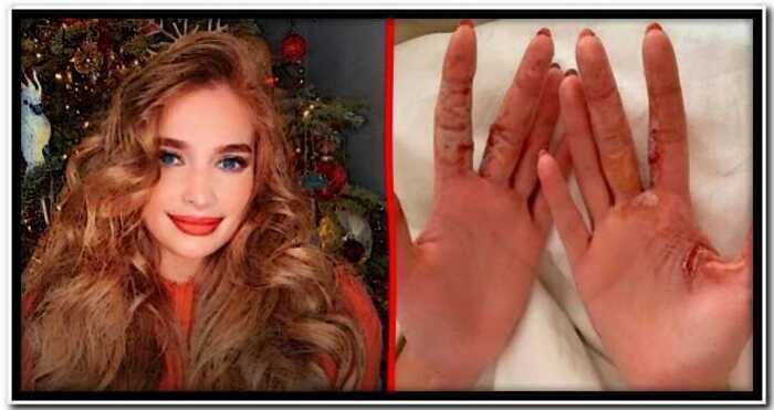 Экс-участница «Виа Гра» Татьяна Котова показала изуродованные бенгальским огнем руки