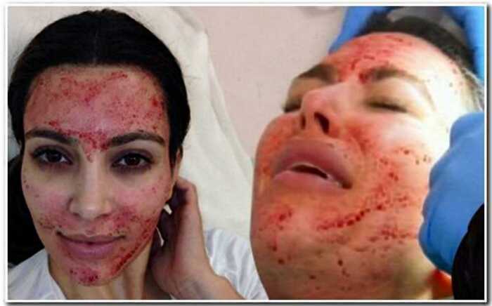 “В погоне за красотой”: Ким Кардашьян прибегла к опасной “вампирской” процедуре на лице