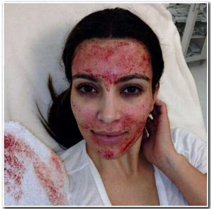 “В погоне за красотой”: Ким Кардашьян прибегла к опасной “вампирской” процедуре на лице