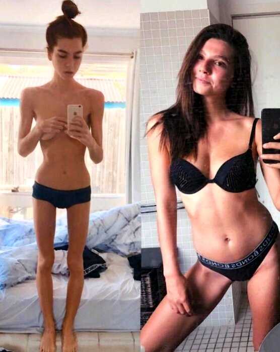 Девушка весом 32 килограмма вышла из комы и победила анорексию!