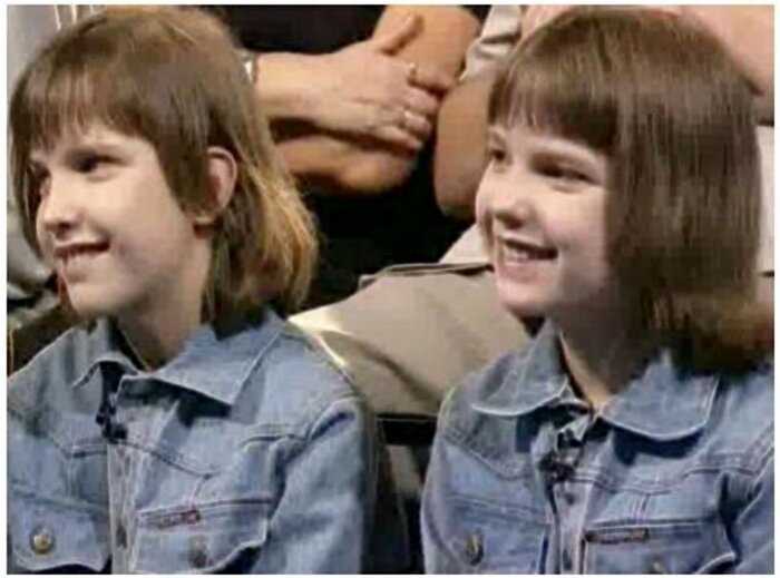 Как сложилась судьба первых удачно разделенных сиамских близнецов в СССР