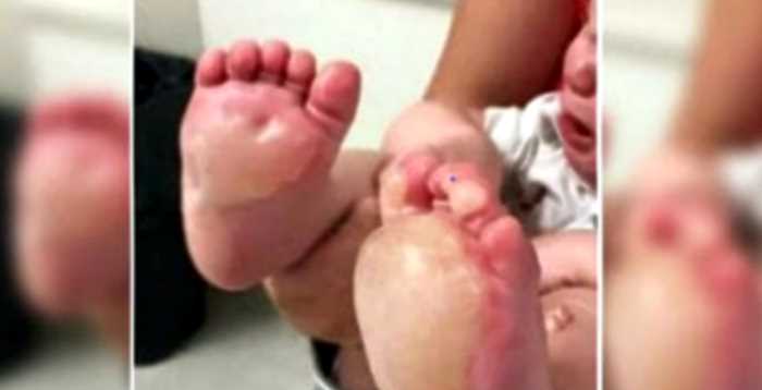 Мама увидела огромные волдыри на ножках у малыша. Правда чуть не разбила ей сердце
