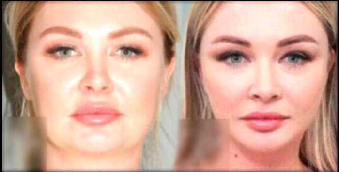 Пластический хирург показал фото Дарьи Пынзарь до и после операции