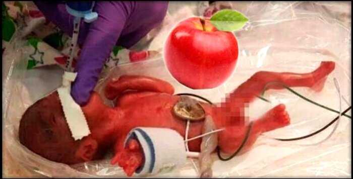 Самая маленькая новорожденная в мире была размером с яблоко