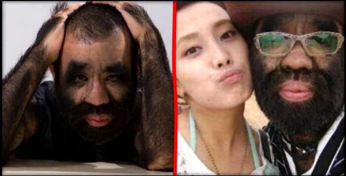 «Человек-обезьяна» как самый волосатый мужчина на планете нашел свою любовь