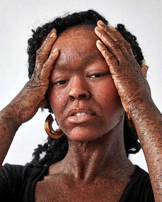 Джейза Гэри – модель со «змеиной кожей», которая сбрасывает её каждые две недели