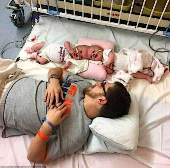 «Сложнейший случай»: в США врачи успешно разделили 1,5-годовалых сиамских близнецов