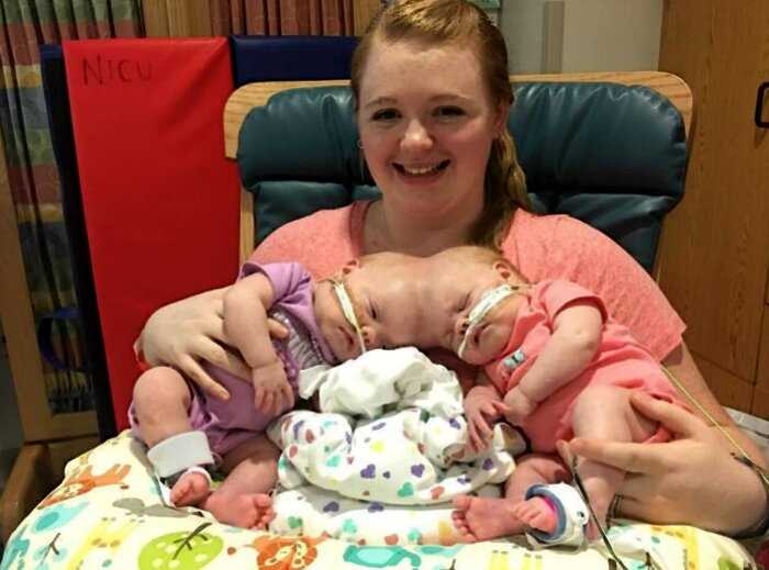 «Сложнейший случай»: в США врачи успешно разделили 1,5-годовалых сиамских близнецов