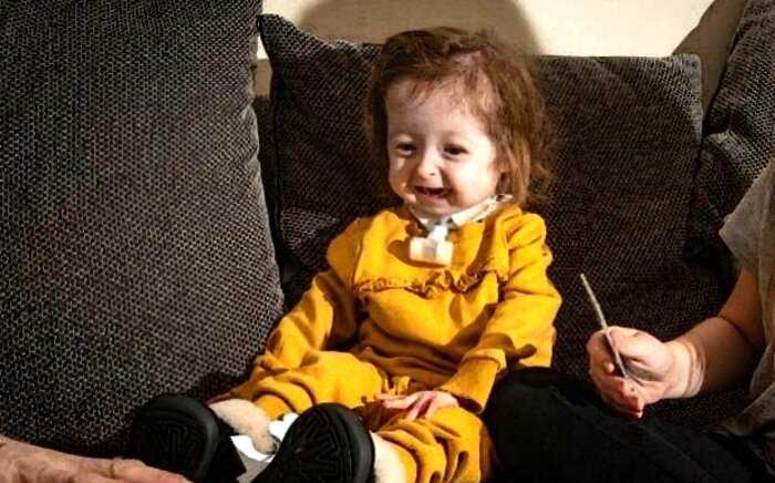 «Маленький Бенджамин Баттон»: история двухлетней девочки, которая выглядит как старушка