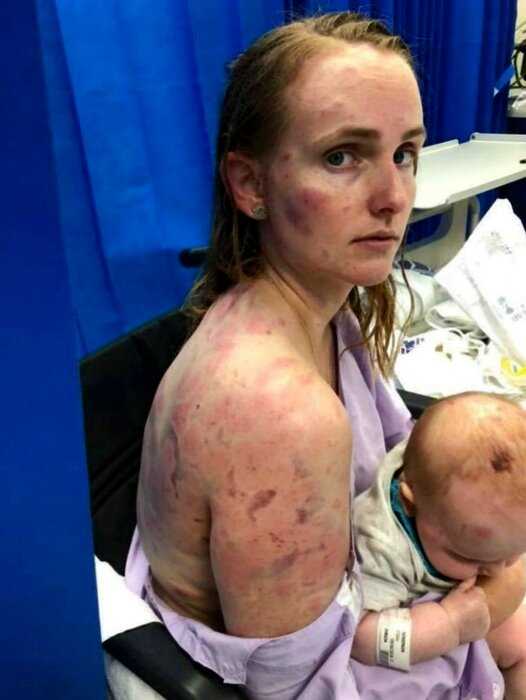 Австралийка закрыла своего ребенка от града — ее тело превратилось в фарш