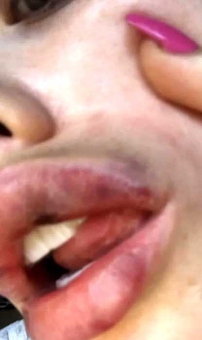 22-летняя американка чуть не лишилась жизни из-за увеличения губ