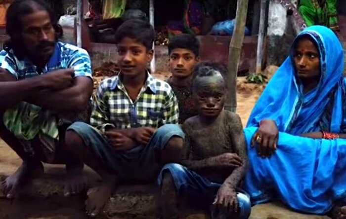 В Индии живет 10-летний «мальчик-змей». Все дело в его редчайшей болезни