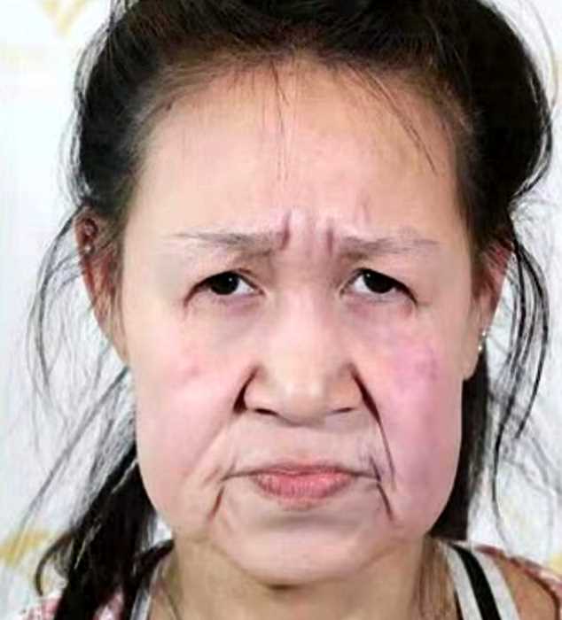 15-летняя китаянка с редчайшим заболеванием прошла через омолаживающую операцию