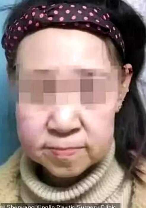 15-летняя китаянка с редчайшим заболеванием прошла через омолаживающую операцию