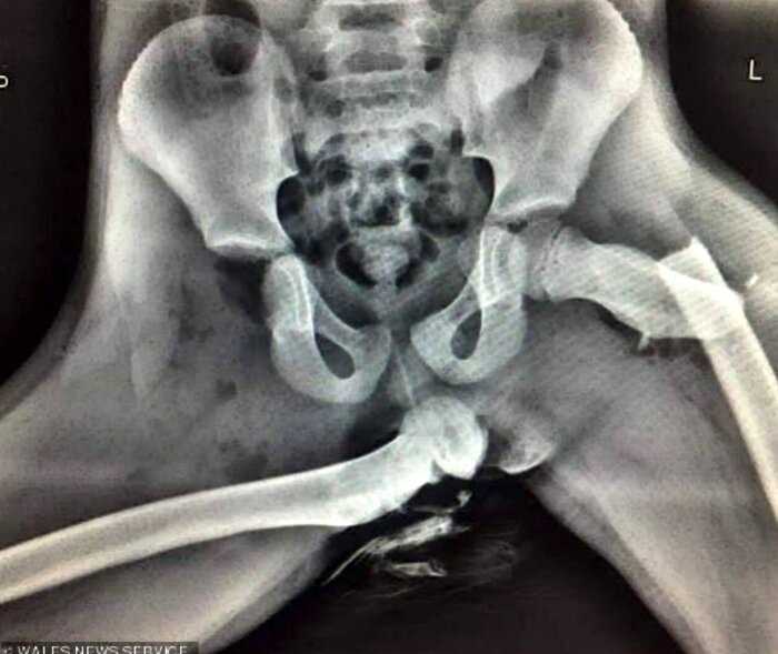 Рентген показал, что может случиться, если вы закидываете ноги на панель авто