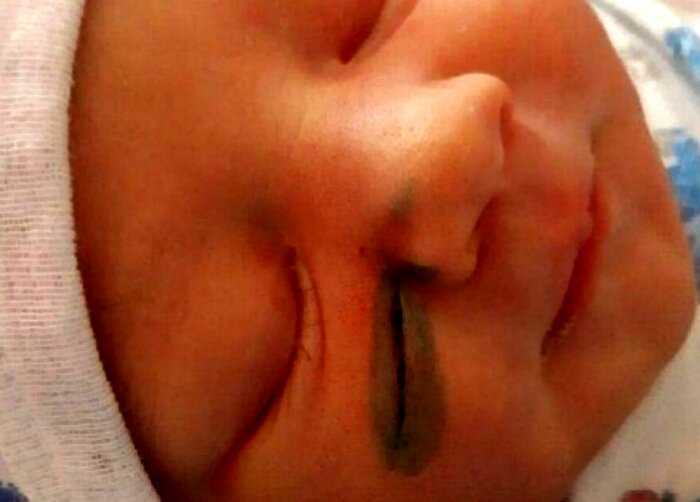 Российские хирурги порезали младенцу лицо во время кесарева сечения