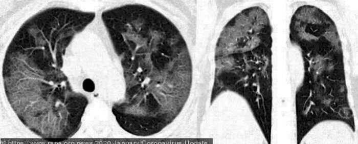 Рентген показал, что коронавирус делает с человеческими легкими