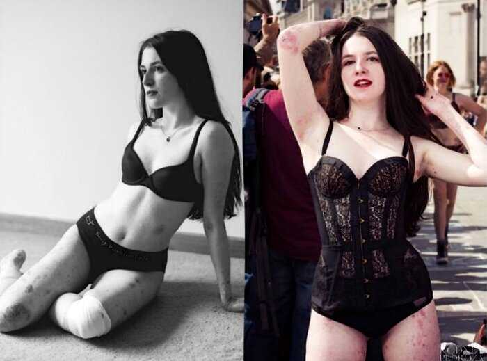 10 фото девушки с «синдромом бабочки», которая сумела стать моделью
