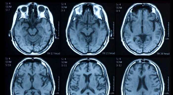 Врачи обнаружили серьёзные повреждения мозга у пациентов с коронавирусом
