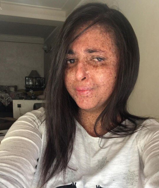 Из-за редкой аллергии на солнце женщина из Марокко ходит в скафандре