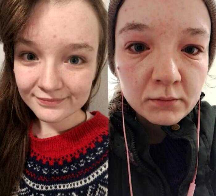 Студентка удивила необычной аллергией на холод, из-за которой её лицо сразу стареет — фото до и после
