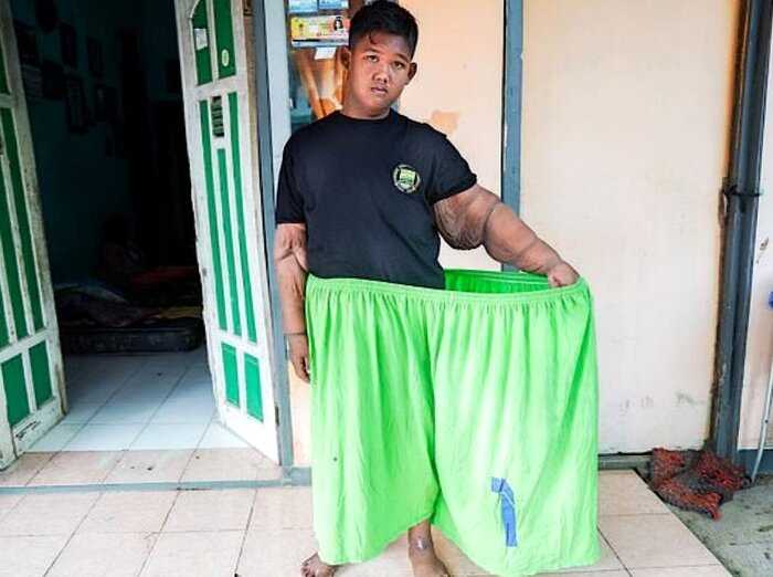 Как после похудения выглядит самый толстый мальчик Индонезии