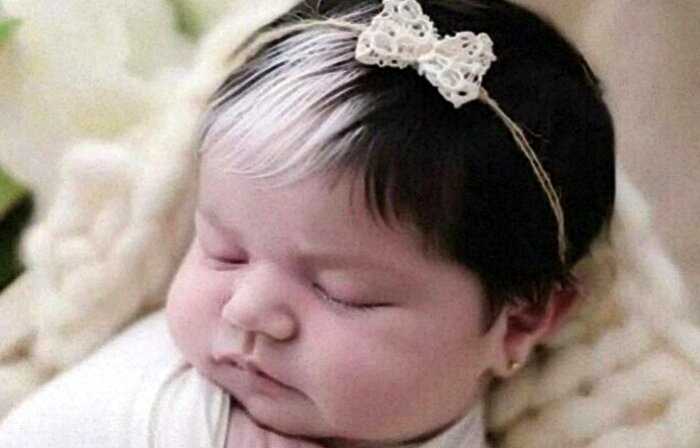 Малышке, которая родилась с белой прядью волос уже 2 года. Как девочка выглядит сейчас?