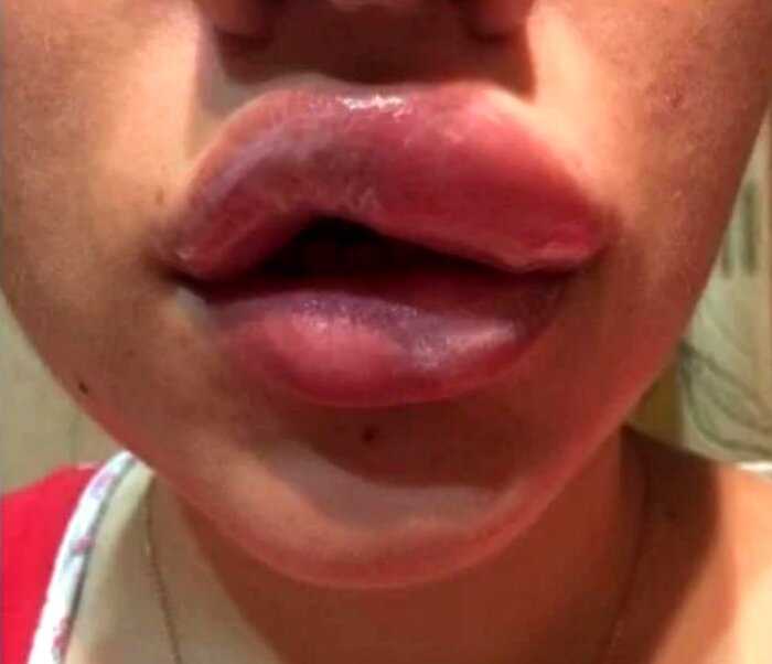10+ фото о том, к чему может привести неудачное увеличение губ