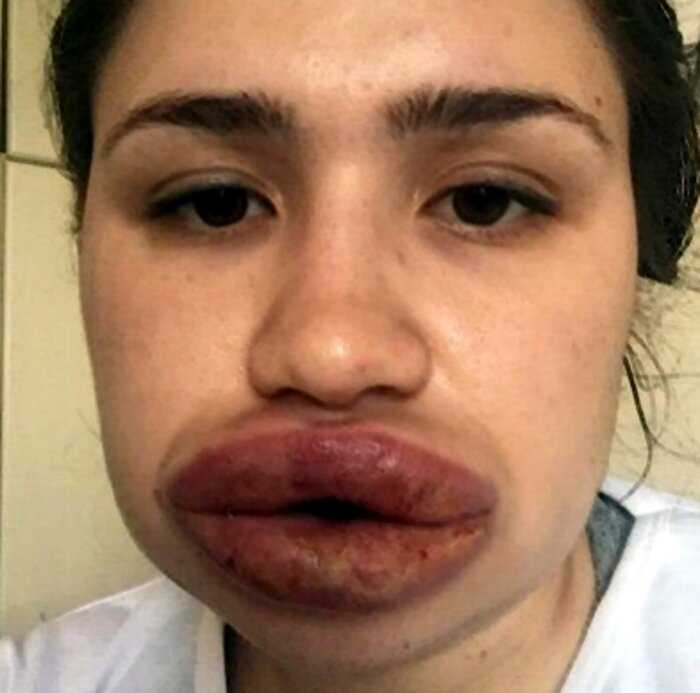 10+ фото о том, к чему может привести неудачное увеличение губ