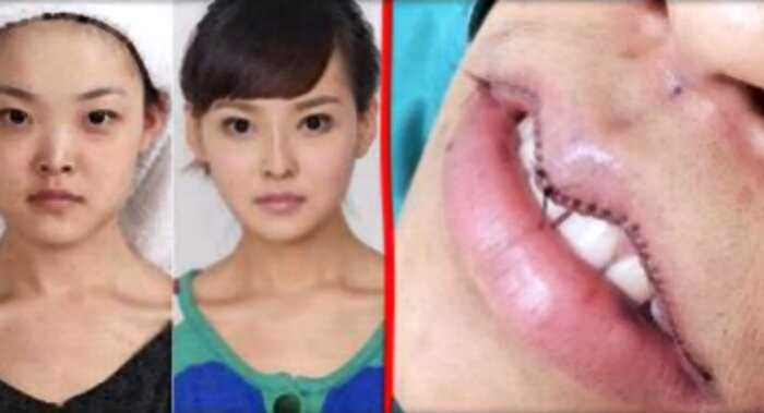 «Вишневые губы и мраморные подбороки»: какие операции популярны в Южной Корее