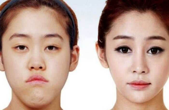 «Вишневые губы и мраморные подбороки»: какие операции популярны в Южной Корее