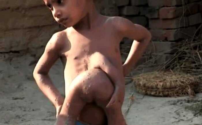 История удивительного мальчика из Индии, который родился с 8 руками и ногами