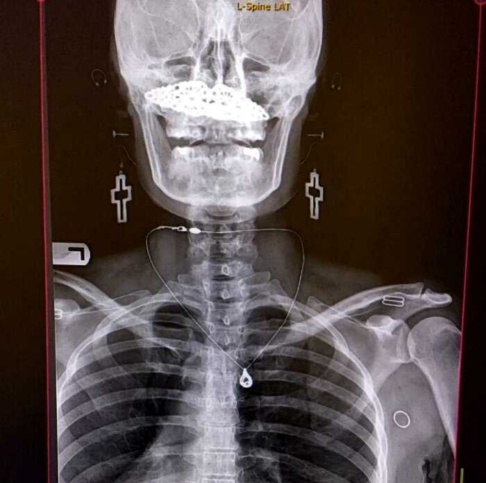 18 шокирующих рентгеновских снимков, которые врачи не забудут никогда