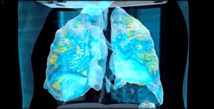 Врач создал 3D-модель лёгких, чтобы показать, как быстро их разрушает коронавирус