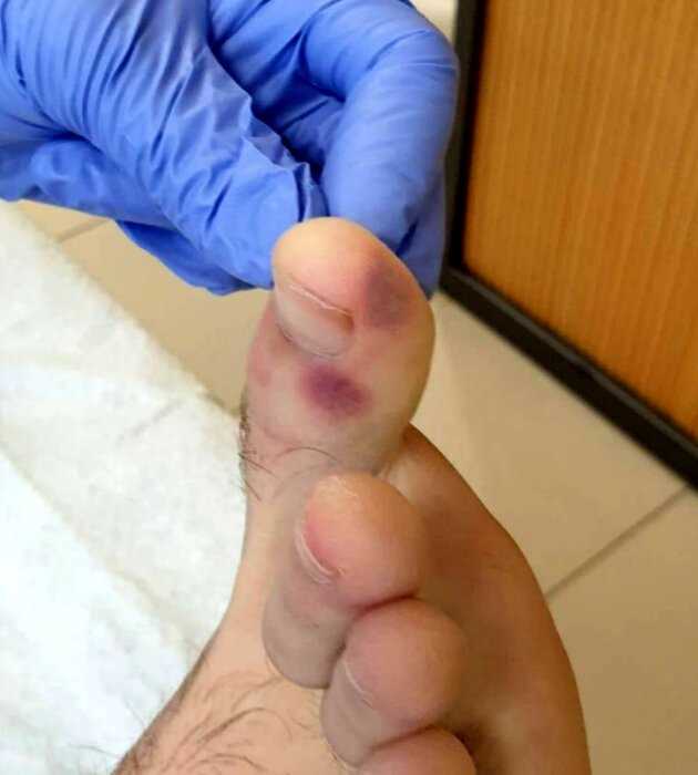 «Смотрите на ноги»: врачи обнаружили неожиданный симптом у больных Covid-19