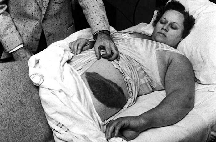 Энн Ходжес — единственный известный человек, пострадавший от прямого попадания метеорита