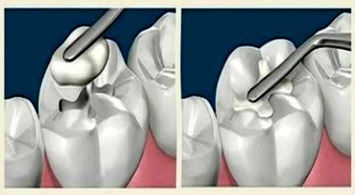 Ученые изобрели вечную пломбу, которая сама будет лечить зуб!