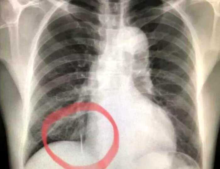 Врачи сделали рентген пациенту и сразу определили его профессию, увидев инородный предмет в лёгких