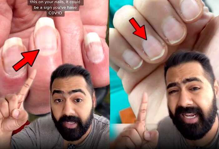 Врач на видео раскрыл, как по одному взгляду на ногти понять, мог ли пациент уже переболеть CoViD
