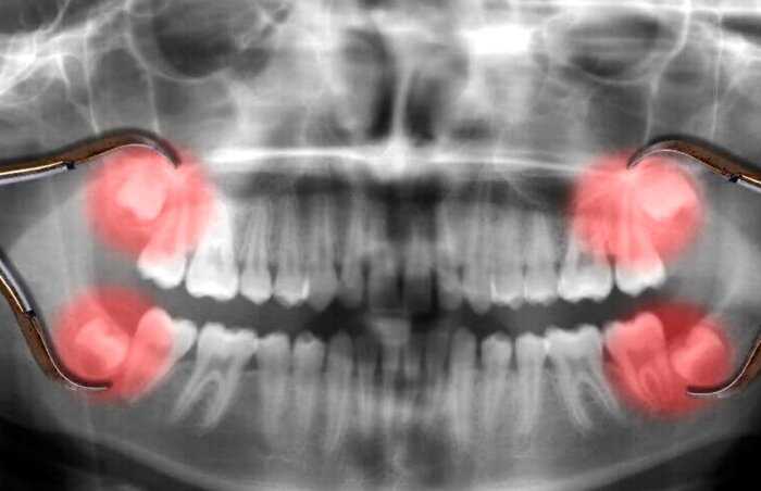 Зачем нужны зубы мудрости и почему они не растут у жителей Мексики