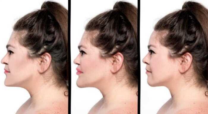 Женщина попросила трех врачей сделать ей модельное лицо: вот что из этого вышло
