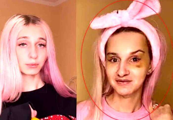 У сменившей пол блогерши Даши Корейки перекосило лицо после операции